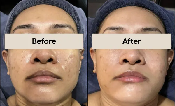 Stellar M22 before and after treatment results